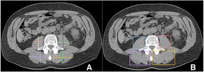 Clinic friendly estimation of muscle composition: Preoperative linear segmentation shows overall survival correlated with muscle mass in patients with nonmetastatic renal cell carcinoma